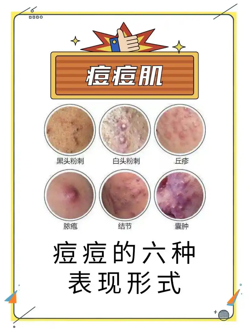 痘痘的六种表现形式,测试一下你是哪一种
