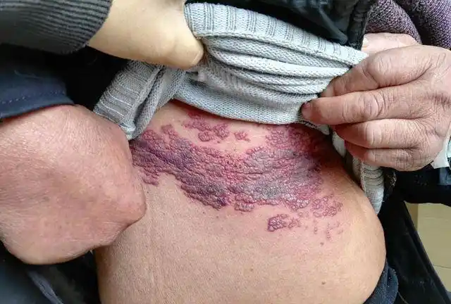 一文解读带状疱疹