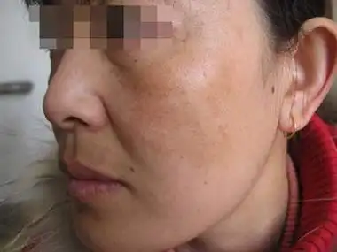 黄褐斑原因有什么_黄褐斑_北京京城皮肤病医院(北京医保定点机构)