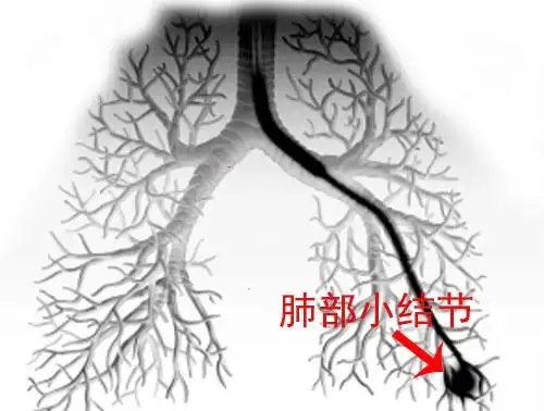 体检发现肺部小结节勿慌!并不等于肺癌