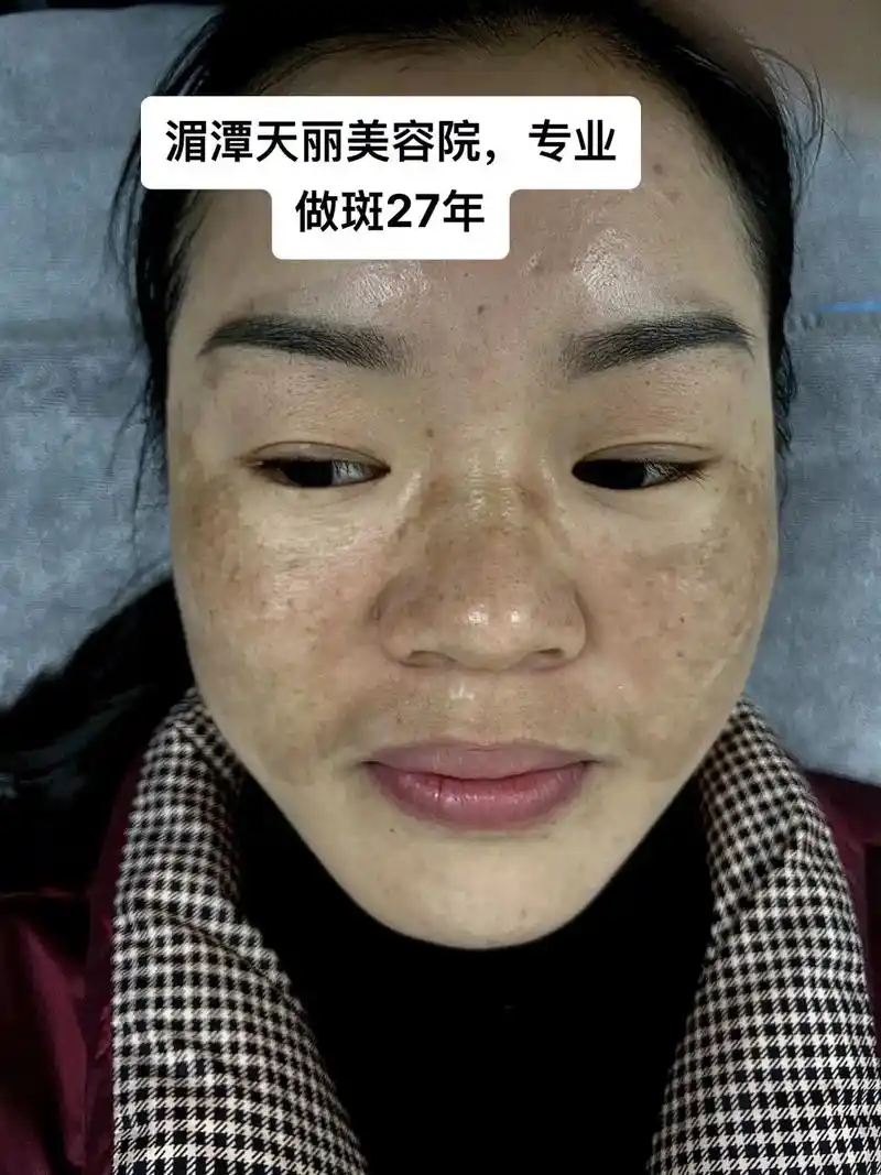 黄褐斑一次做干净需要长期维护才能保持一个很好的状态95 - 抖音
