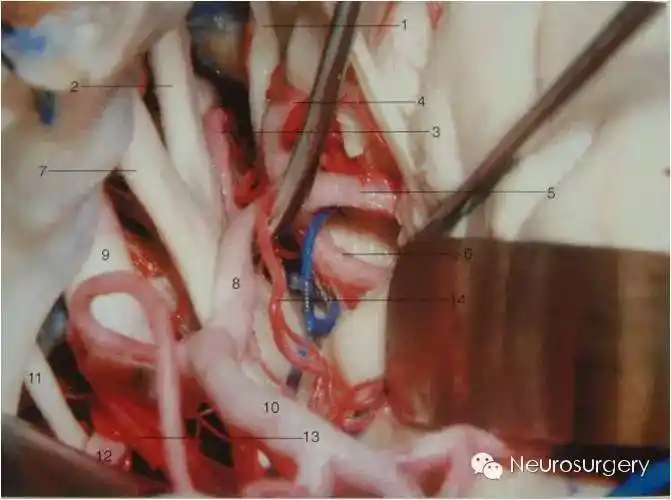 干货额颞开颅翼点入路