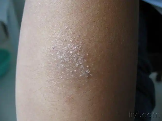 苔癣样皮疹