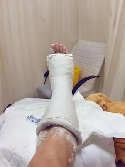 马浴柯腿打石膏