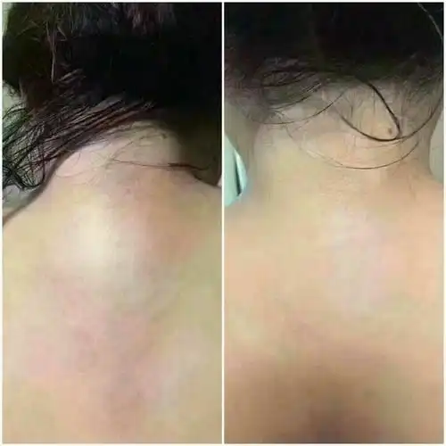 富贵包调理前后