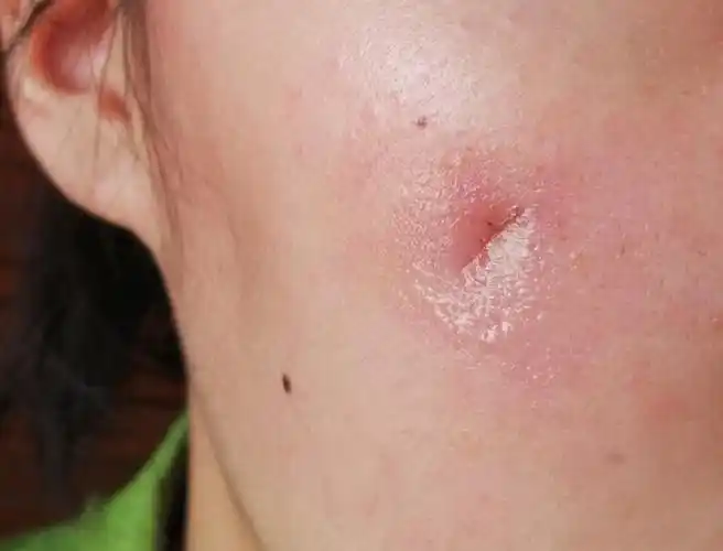 皮脂腺囊肿手术第七天拆线啦