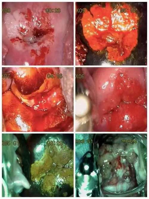 女性健康,从宫颈癌筛查开始