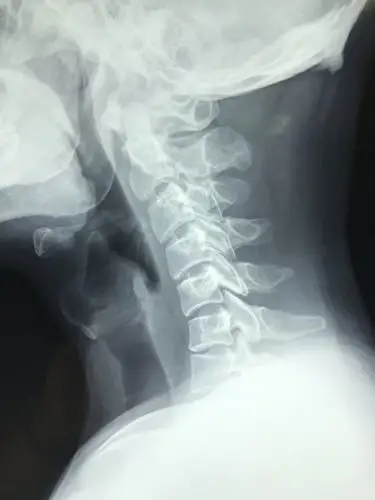 颈椎病的微创治疗 - 好大夫在线