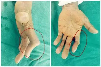 纽孔畸形一朝治愈