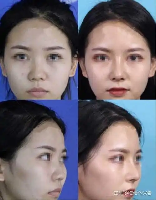 手术方式:肋软骨鼻综合 具体项目:垫高山根鼻背 鼻小柱延长 鼻尖塑形