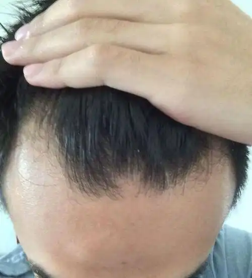 20岁m型脱发长回来了20岁m型脱发能恢复吗