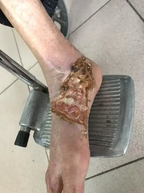 老烂腿,治疗不再遥遥无期 - 好大夫在线