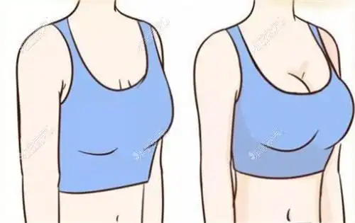 哈尔滨乳房上提手术亲身经历,乳房悬吊术-乳房再造姐妹必看-非常爱美