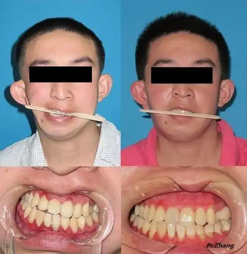 成人第一,二腮弓综合症的综合手术重建 - 好大夫在线