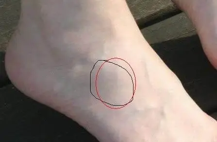 脚崴了,现在这块骨头摸着有明显的突起,请问一下这个骨头叫什么名,我