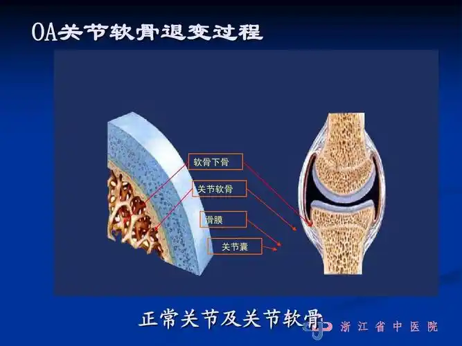 oa关节软骨退变过程 软骨下骨 关节软骨 滑膜 关节囊 正常关节及关节