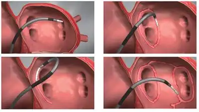 房颤射频消融示意图什么是射频消融术?