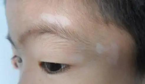 白癜风造成的威胁有哪些?