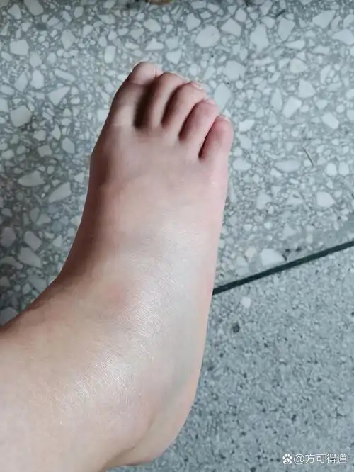 随便一摔就这样了😿 前两天下雨,骑电动车转弯的时候在泥巴上打了一