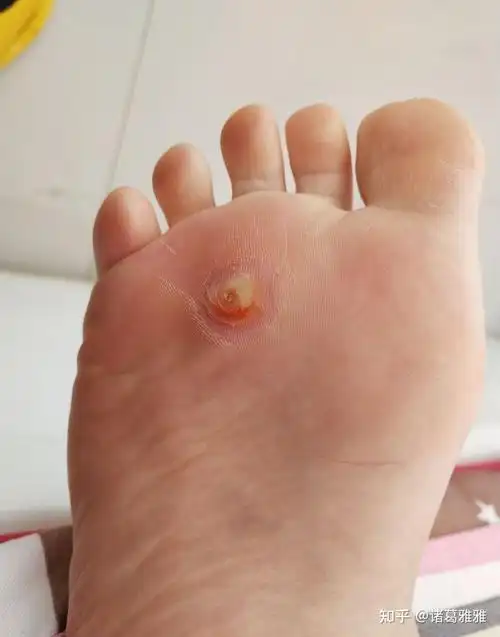 鸡眼怎么去除? - 知乎