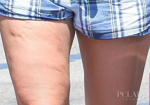 橘皮组织是凸凹不平的,一种脂肪堆积不均匀的现象.