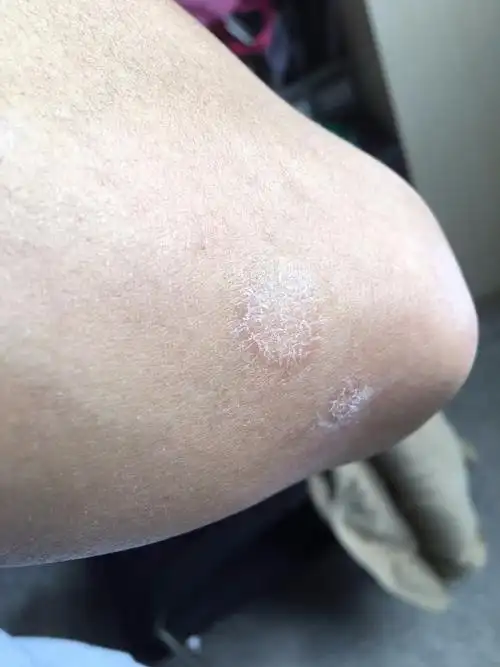 胳膊上长的什么癣