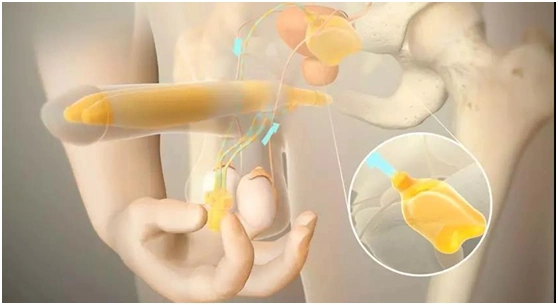 人工海绵体植入是怎样的?