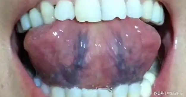 朋友往往会出现舌色发紫,有瘀斑的情况,而且舌头下面的血管也会非常粗