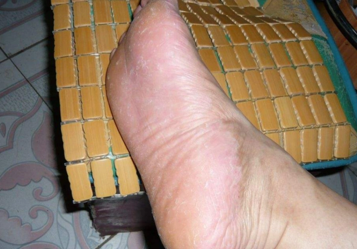 手藓足藓症状图片_有来医生