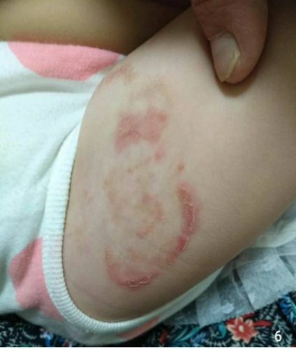 品头癣论足癣浅谈儿童皮肤癣菌病