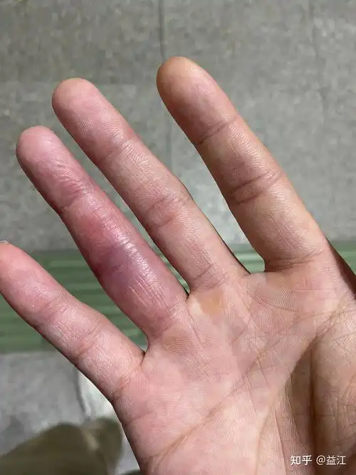 分享一下右手无名指肌腱断裂保守治疗过程