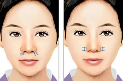 鼻头缩小卡通 span style=