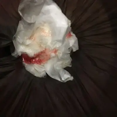 开始吐的是深色血,最后一口出来就是这样的鲜血了.