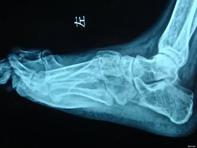 第一跖骨陈旧性骨折畸形愈合