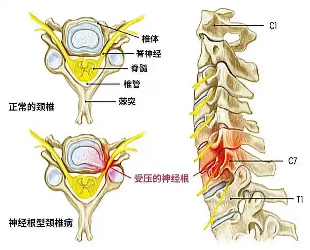 颈椎的小关节,韧带等增生压迫刺激颈部脊髓,神经根等结构并出现与影像