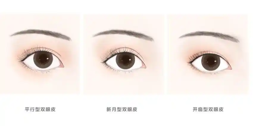双眼皮眼型平行型新月型开扇型