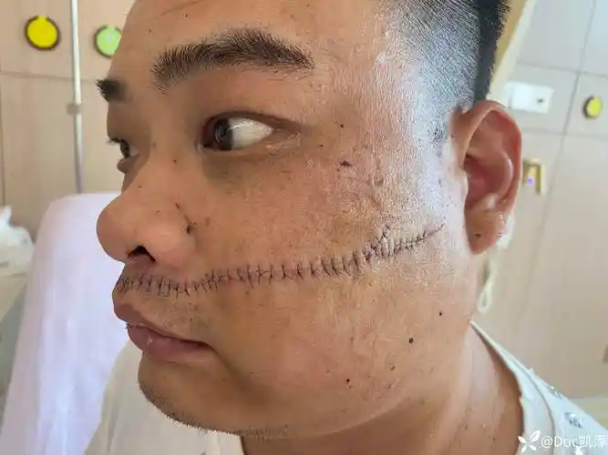 罕见面部超长外伤裂口,床旁缝完天亮了…#美容缝合