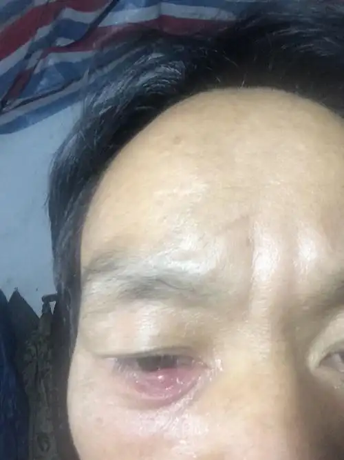 下眼皮有个红疮是什么情况?这样怎么处理