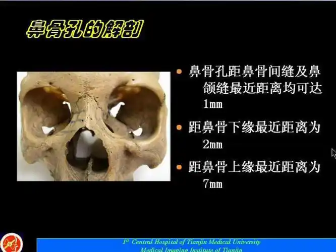 鼻骨孔-鼻骨骨折诊断的误区及临床_第4页