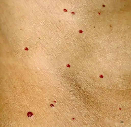 皮肤科医生和你聊聊什么是樱桃状血管瘤需要如何处理