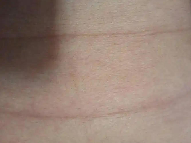 肚子上有一条一条痕迹怎么办?怎么能消除