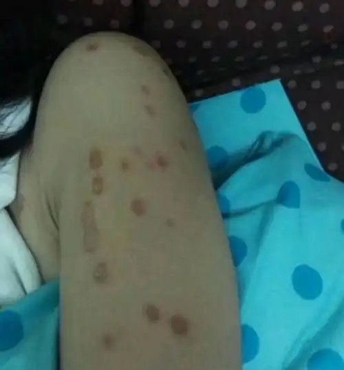 女子吸猫不幸得了猫癣面部留下多处疤痕吸猫有风险需谨慎