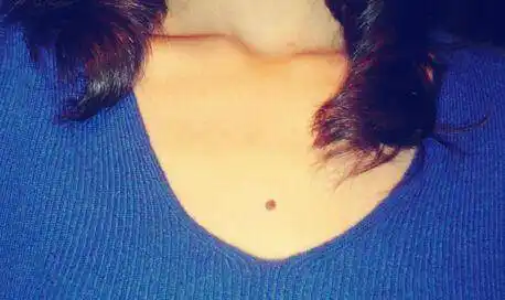 女孩胸口正中间有痣意味着什么女孩胸口长痣好不好