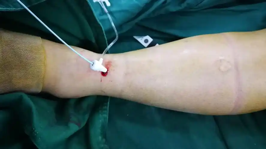 下肢深静脉血栓导管接触溶栓…赣州市立医院介入血管外科