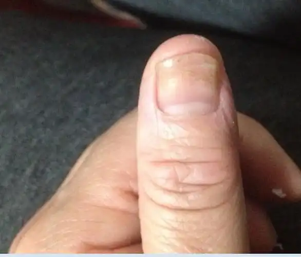 大拇指指甲突起 这是什么病?