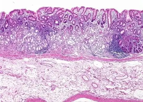 有慢性萎缩性胃炎怎么办