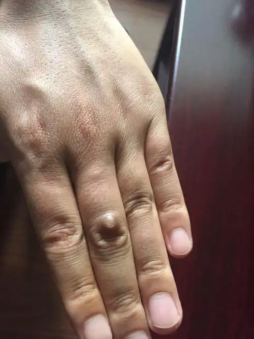 手背上起硬结考虑什么?