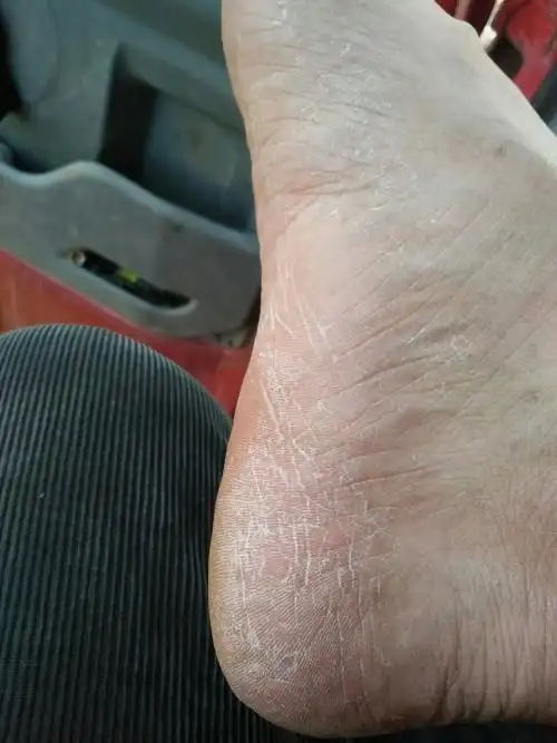 脚干,脱皮谁有好的治疗方案,已经九年了,一直没治过?