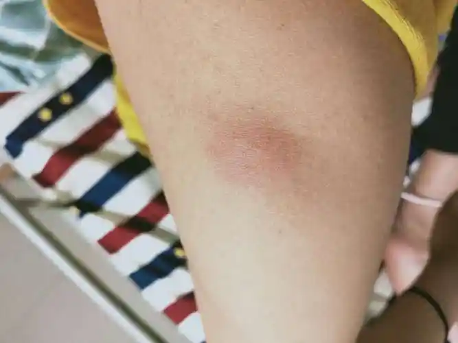 【艾滋病皮疹图片】当出现这些皮疹症状,立即做艾滋病检查