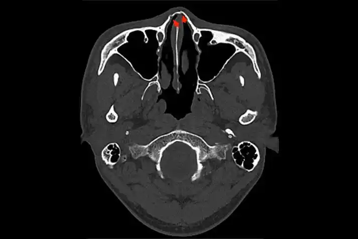 鼻骨骨折影像图